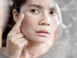 Bagaimana Cara Menghilangkan Flek Hitam di Wajah dengan Cepat