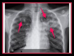 Bagaimana kondisi paru-paru pada penderita tuberkulosis TBC